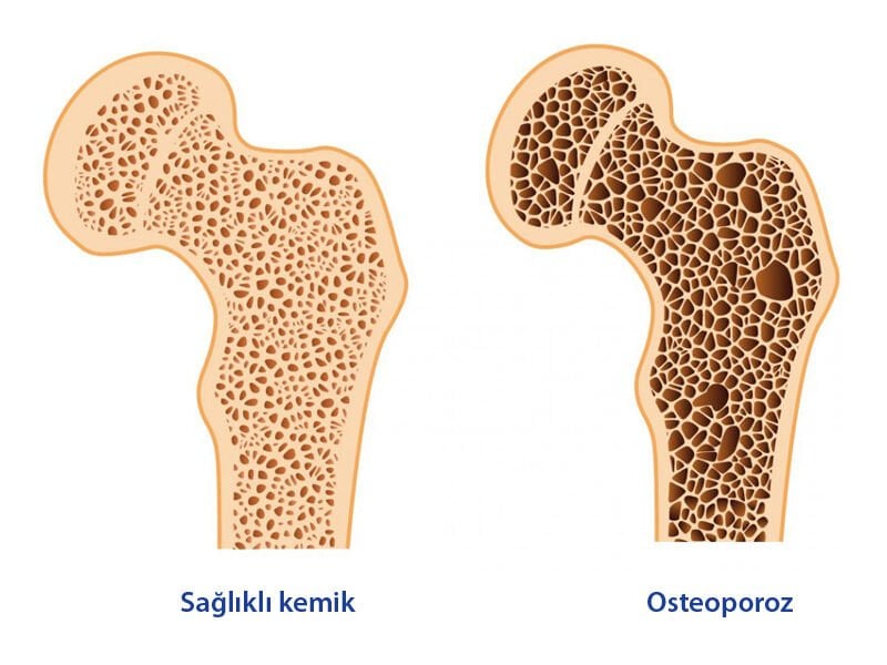 Zeytinyağı kemik sağlığı üzerindeki etkisi artık epidemiyolojik gözlemin ötesinde, randomize klinik çalışmalarla belgelenen bir bilimsel gerçektir. PREDIMED kohortundan Bonolive randomize çalışmasına, çocuklarda kemik gelişiminden postmenopozal osteoporoz korumasına güncel bilimsel kanıtlar bu yazıda.