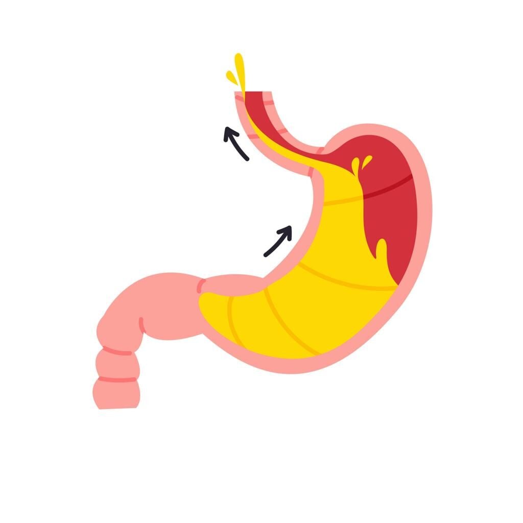 Reflü yalnızca asit fazlalığından ibaret değil. Mide ile yemek borusu arasındaki kapak mekanizması, sindirim yükü ve beslenme kalitesi de reflüyü doğrudan etkiler. Yüksek polifenollü zeytinyağının destekleyici rolünü bilimsel çerçevede ele alıyoruz.