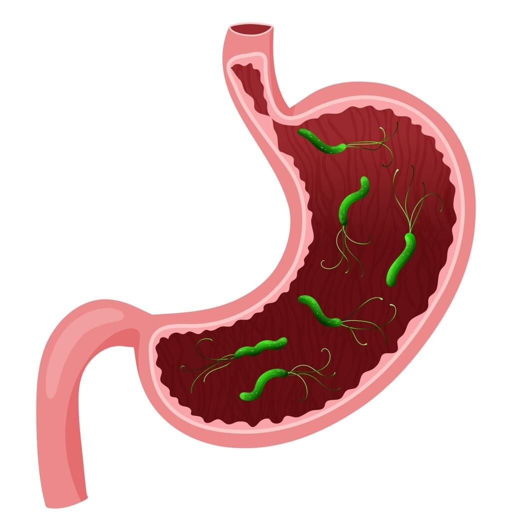 Helicobacter pylori tekrar mı etti? Antibiyotik direnci artıyor. Bakterinin mide ortamında nasıl hayatta kaldığı, neden kronikleştiği ve beslenmede nelere dikkat edilebileceği bu yazıda.